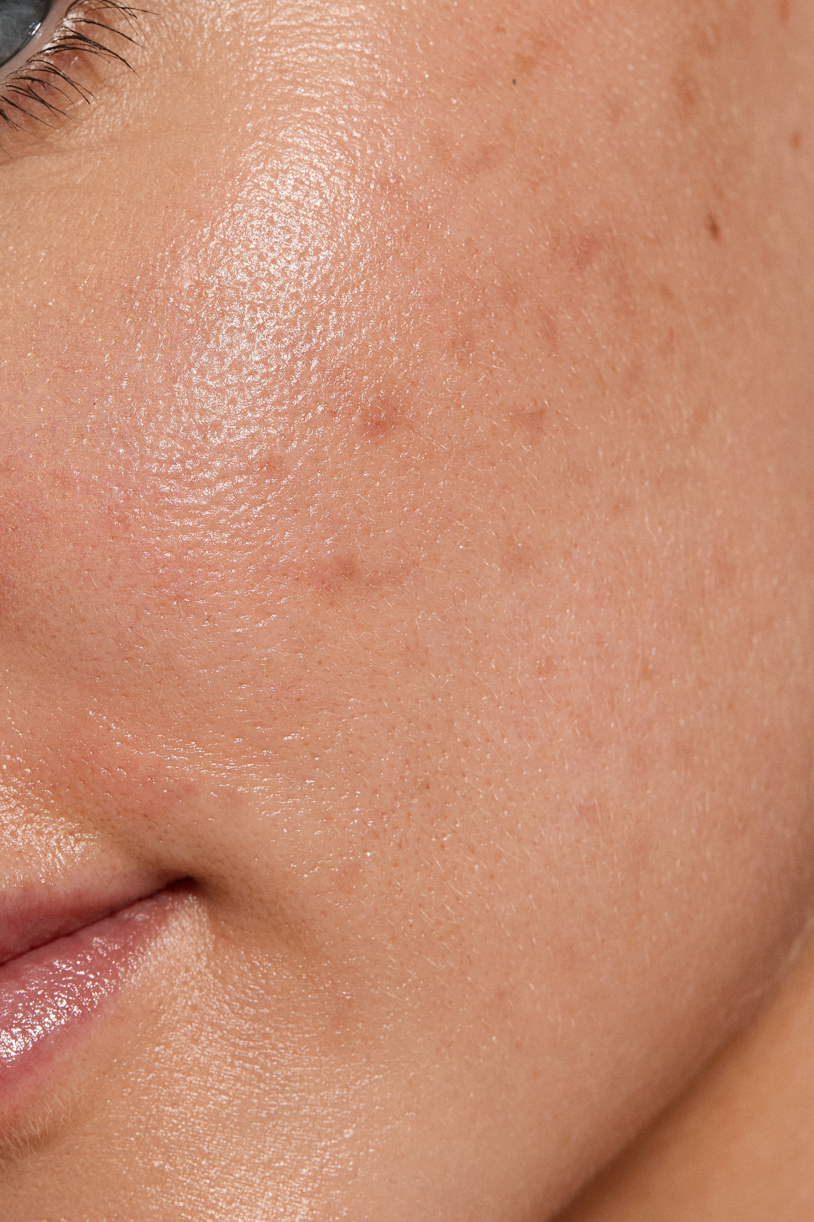 Close-up of a woman's face with minimal acne and dark spots, demonstrating the effectiveness of medical aesthetic treatments in addressing these skin concerns.